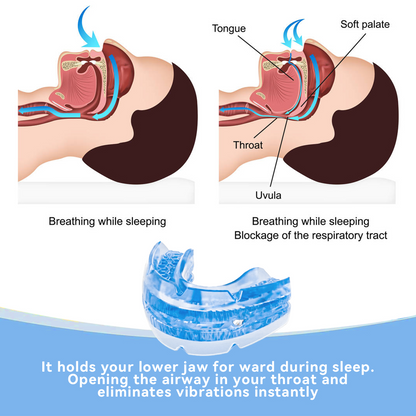 Adjustable Tooth Socket Night Anti-wear Screw Adjustment